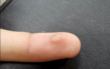 Điều Trị Mụn Cóc