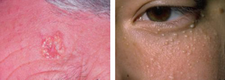 Điều Trị Mụn Thịt