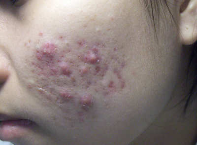 Điều Trị Mụn Bọc Tận Gốc Với Công Nghệ Spectra Peel Laser