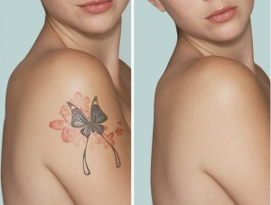 XÓA XĂM VÀ CÁC PHƯƠNG PHÁP 