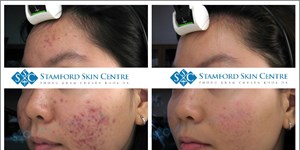 HIỆU QUẢ ĐIỀU TRỊ MỤN