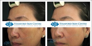 HIỆU QUẢ ĐIỀU TRỊ LÃO HÓA DA