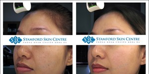 HIỆU QUẢ ĐIỀU TRỊ NÁM - TÀN NHANG