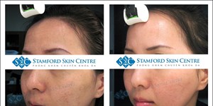 HIỆU QUẢ ĐIỀU TRỊ SẸO RỖ