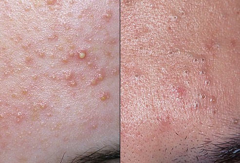 Có cách điều trị mụn nào bằng phương pháp tự nhiên hiệu quả không?